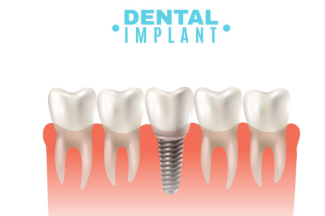 missing tooth problems when is dental implant the right solution